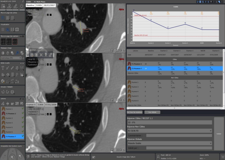 Myrian XL Onco - Une solution révolutionnaire pour une surveillance précise et efficace du cancer