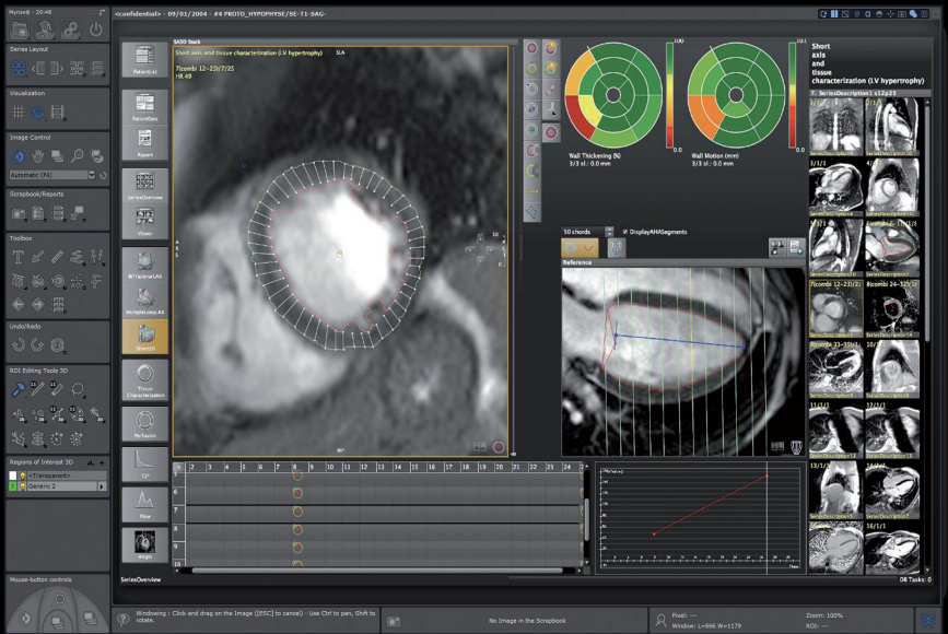 Application d'analyse d'images IRM cardiovasculaires